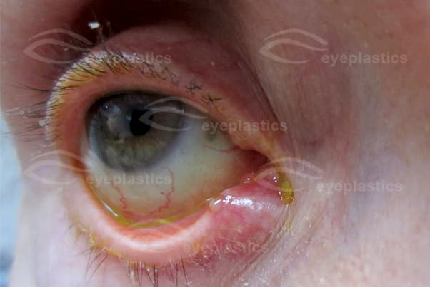 Pouting punctum with discharge โ right lower eyelid